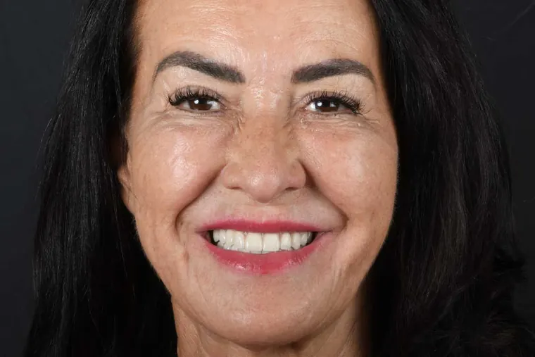 Después · Implantes dentales