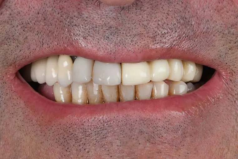 Antes · Carillas + Implantes