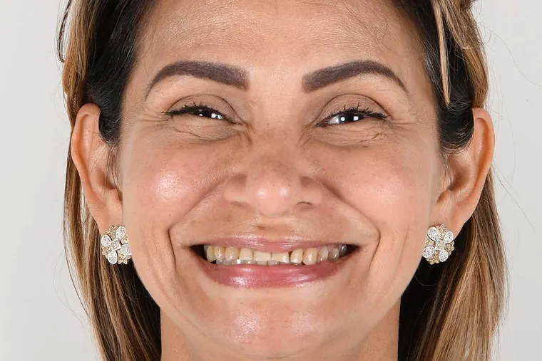 Antes · Implantes y carillas de cerámica