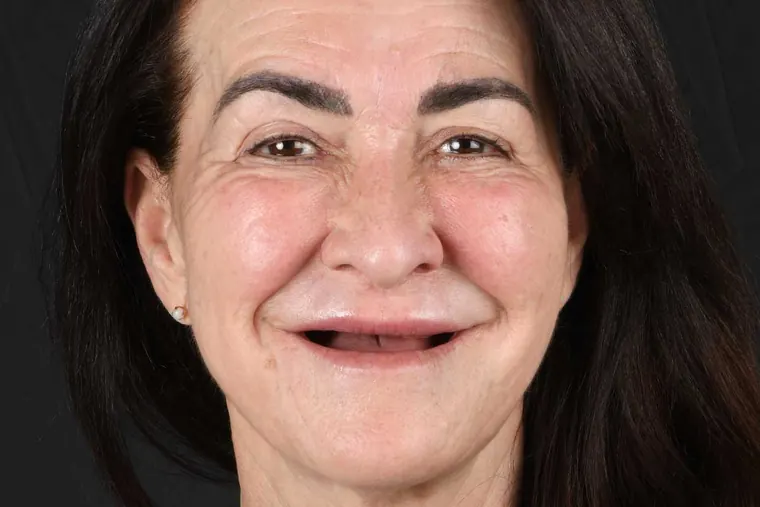 Antes · Implantes dentales