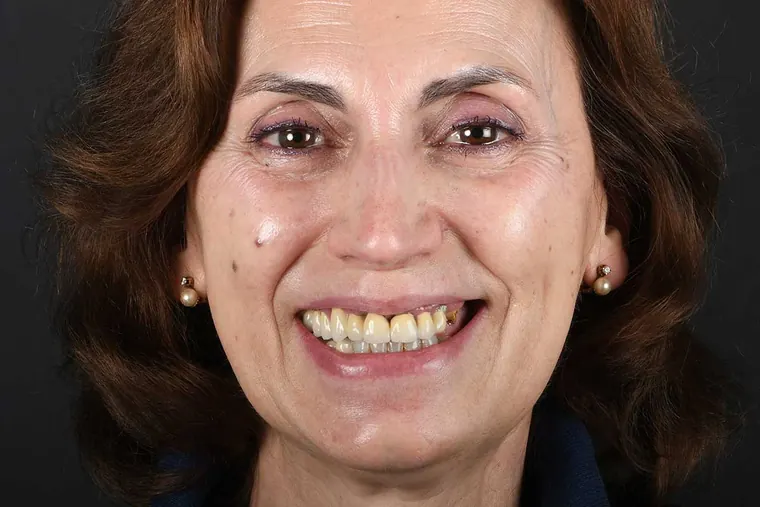 Antes · Implantes + Carillas de cerámica