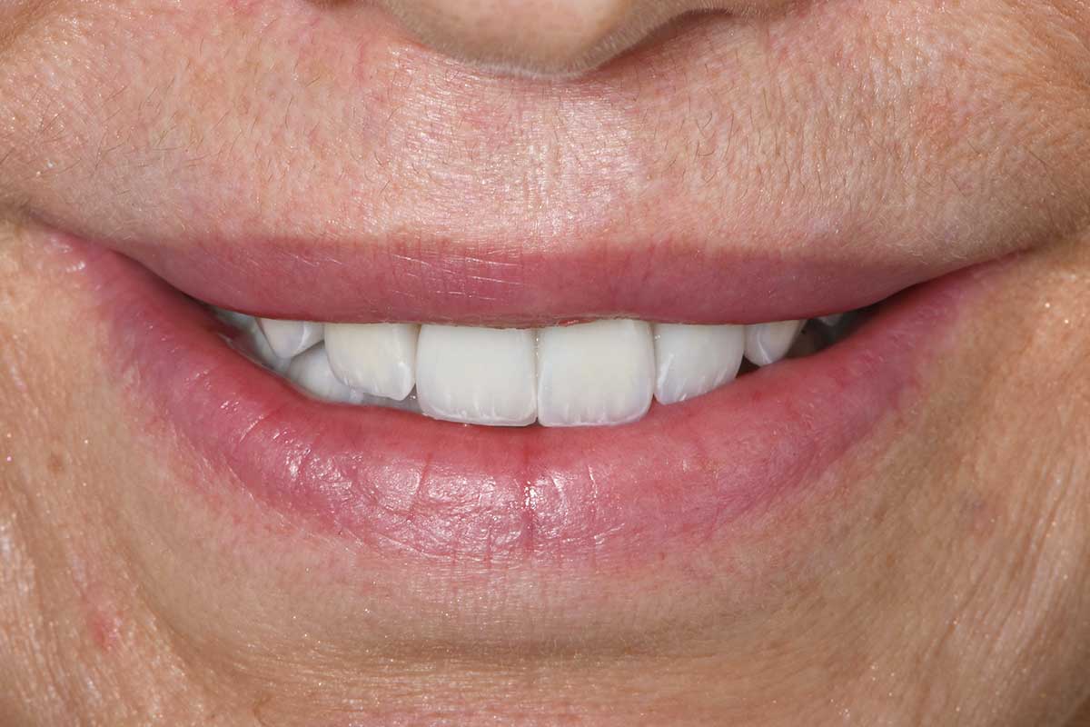 Blanqueamiento dental profesional en Sevilla
