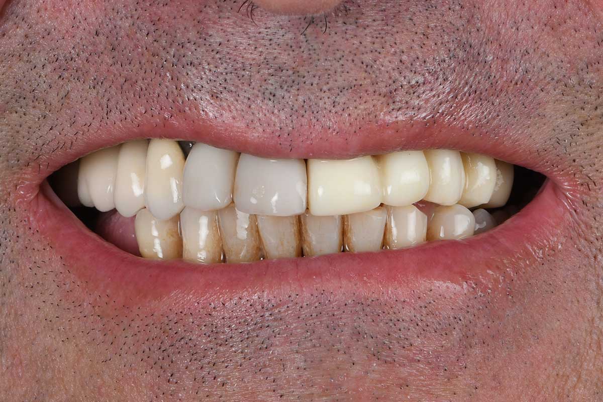 Coronas dentales de porcelana y zirconio en Sevilla