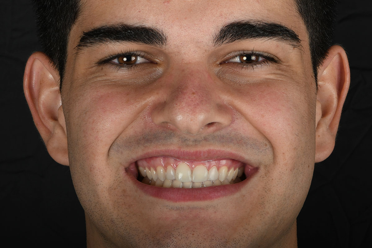 Ortodoncia invisible Invisalign en Sevilla